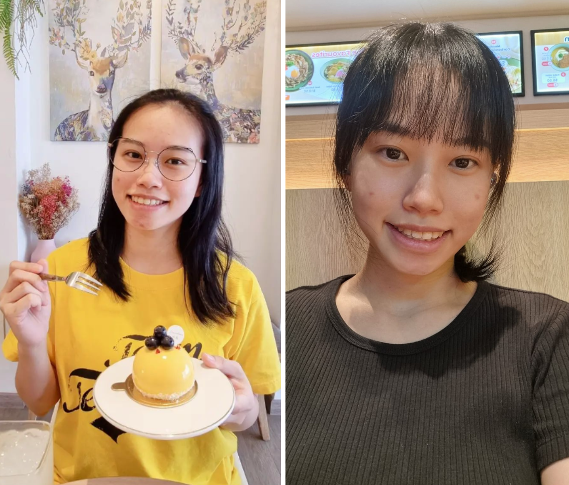 Having experienced acne from the age of 13, Xiaojie’s main skin concerns were to manage breakouts and address the post-inflammatory hyperpigmentation (PIH) on her cheeks, chin and forehead. 