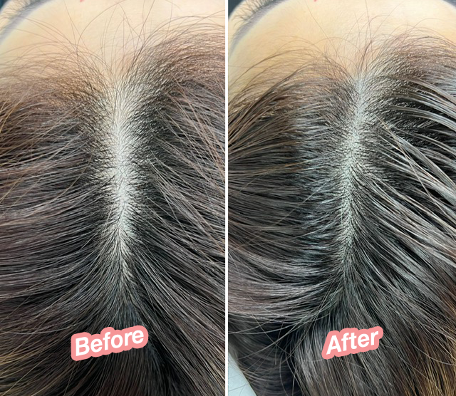 Depending on your scalp condition, the effect of scalp micropigmentation last for 3-5 years.