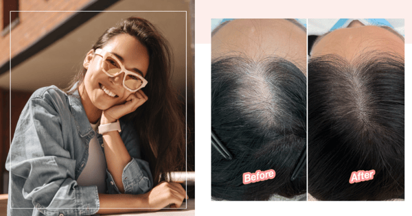 Balding Or Thinning Hair? This Scalp Pigmentation Treatment Will Be Your Secret Weapon