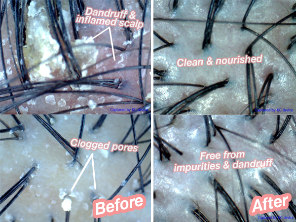 Goodbye, disgusting dandruff and hello, healthy scalp.