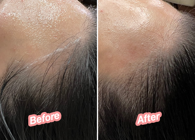 Scalp Micropigmentation is not painful, and requires no recovery or down time.