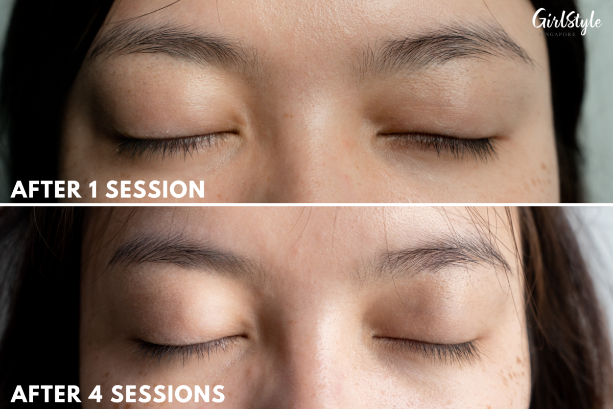 After one session & after four sessions of the Plasma Lift