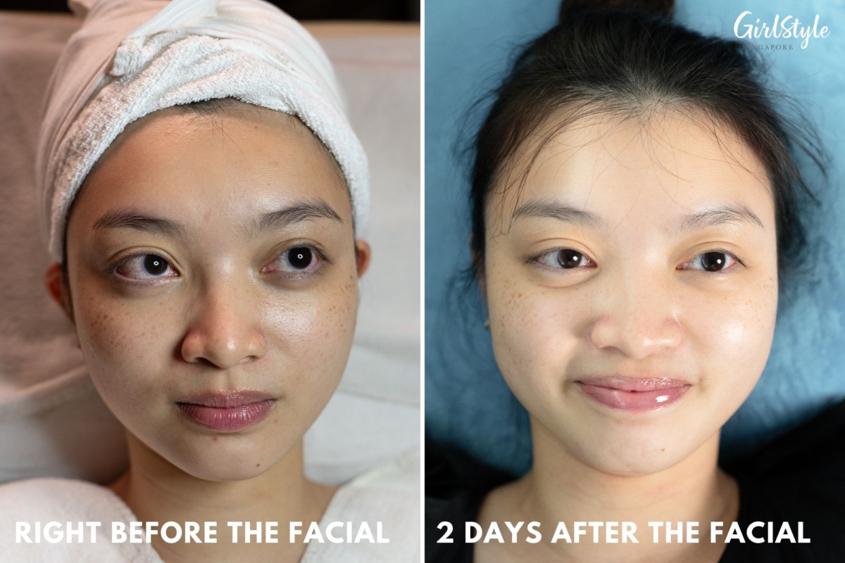 My skin condition, before and after the facial
