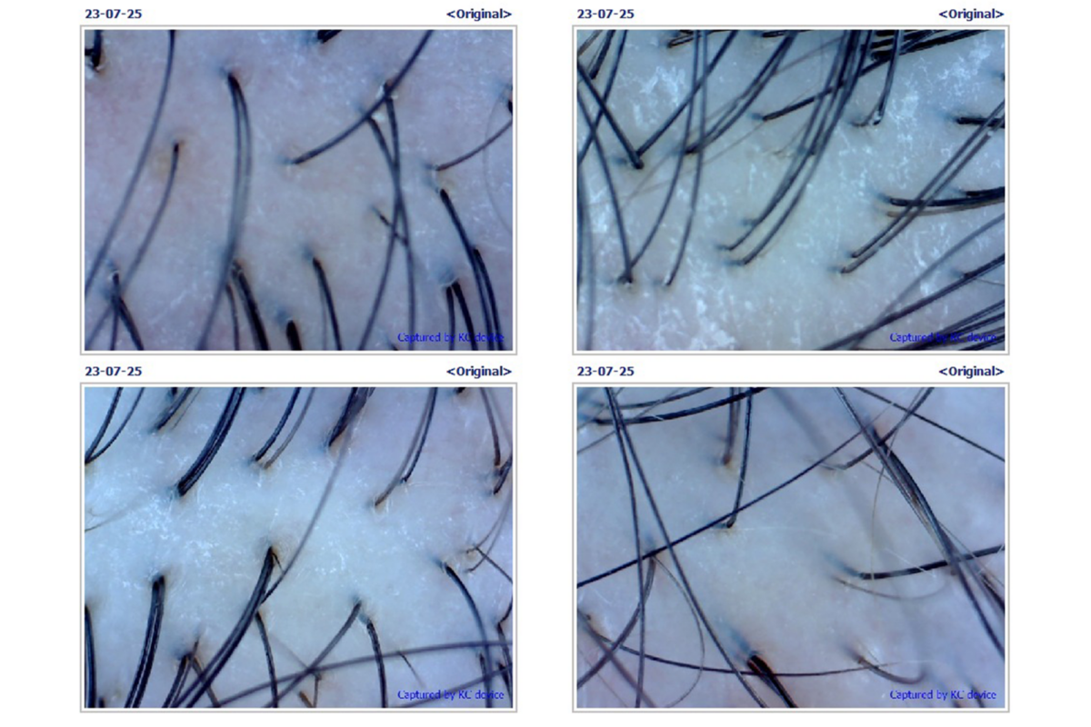 My scalp became visibly cleaner after the treatment, with fewer flakes and no oil deposits