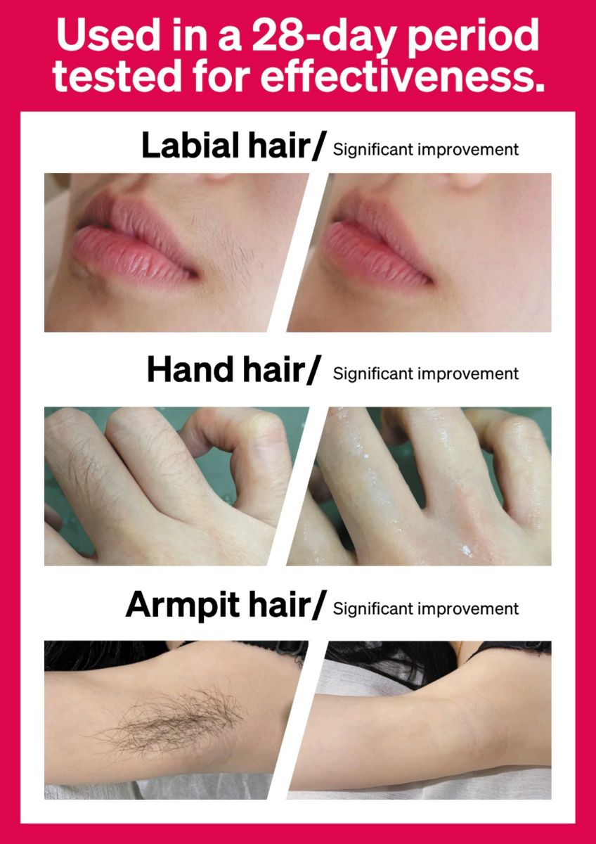 Before and after using Ulike’s Air3 Sapphire Hair Removal Device