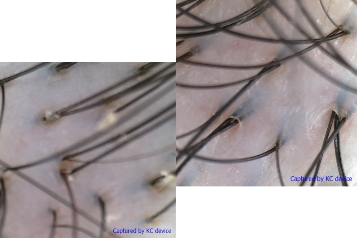 The state of my scalp before (left) and after (right) the treatment
