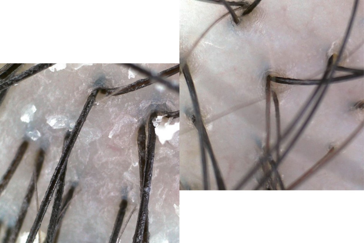The state of my scalp before (left) and after (right) the treatment