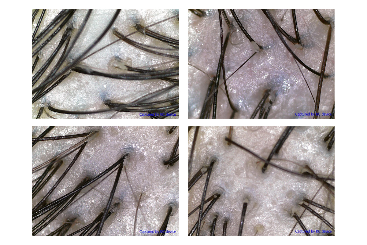 The Tricho-scan revealed that my hair was plagued by oil deposits and dead skin cells