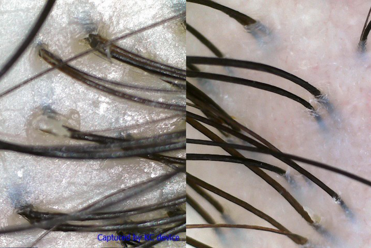 Before (left) and after (right) treatment scans showed that my scalp was now free from any flakes and oil clogs