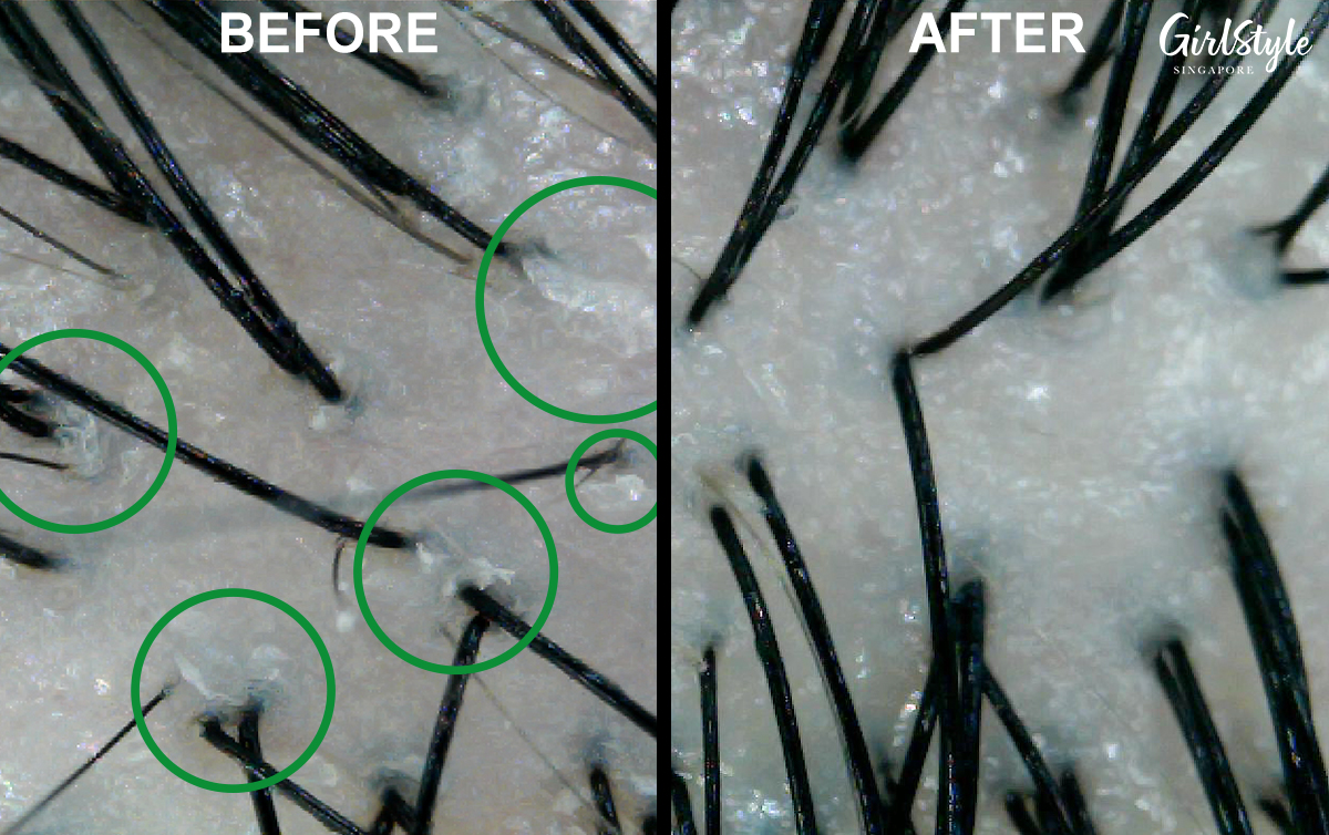 Before the treatment (left) my scalp had an oily surface and clogged pores, while the post-treatment scan showed healthy hair follicles free of dandruff