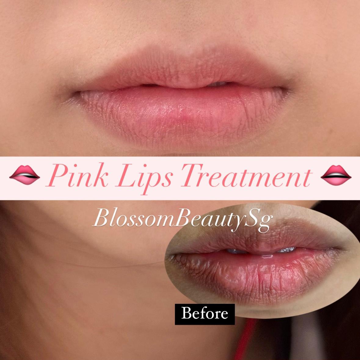 Pink Lips Treatment