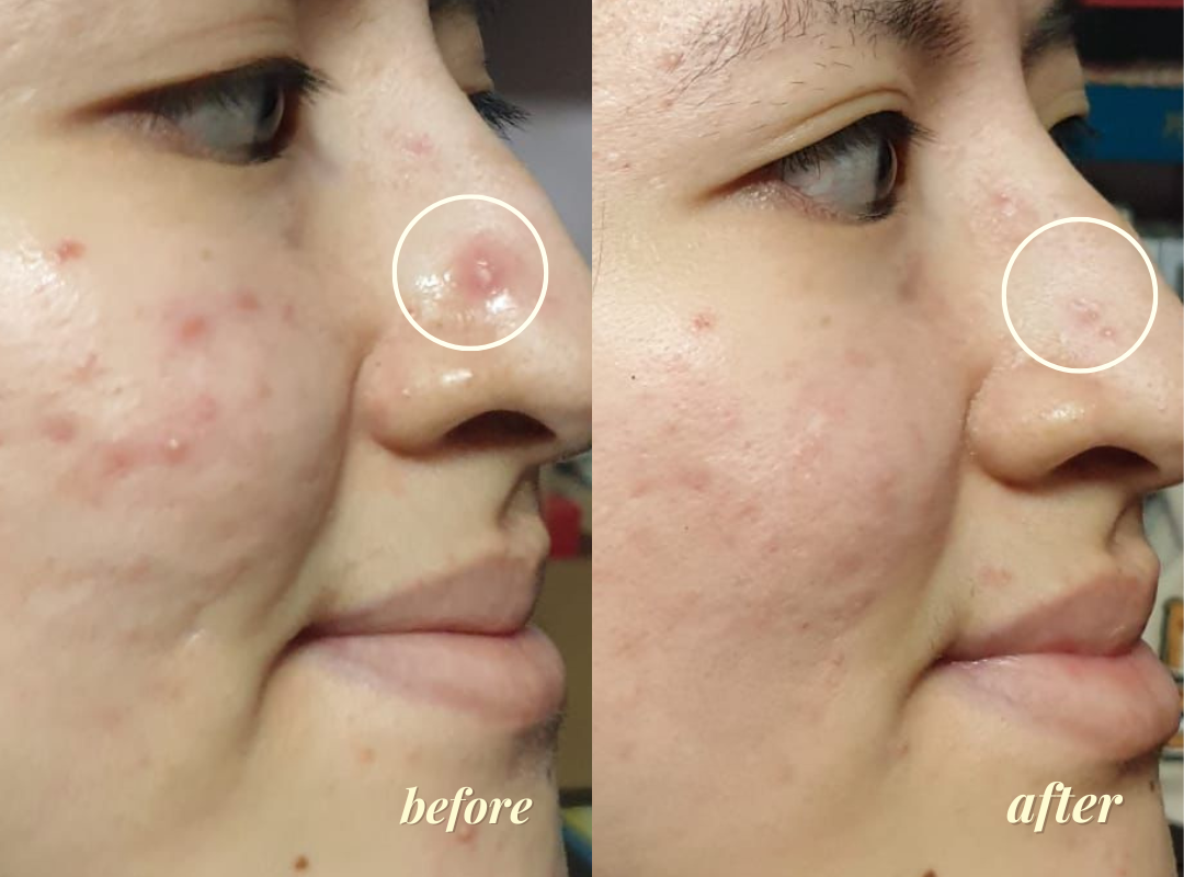 Before and after using BeKind Clear Skin Elixir
