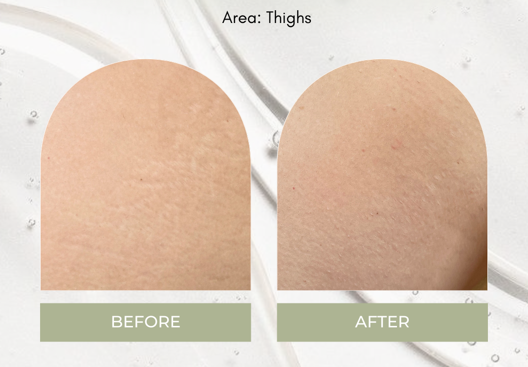 Inkless Skin Camouflage Treatment