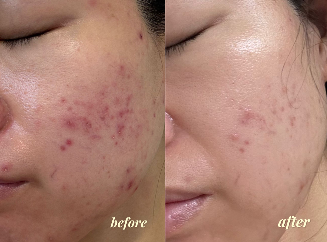 Before and after using BeKind Clear Skin Elixir