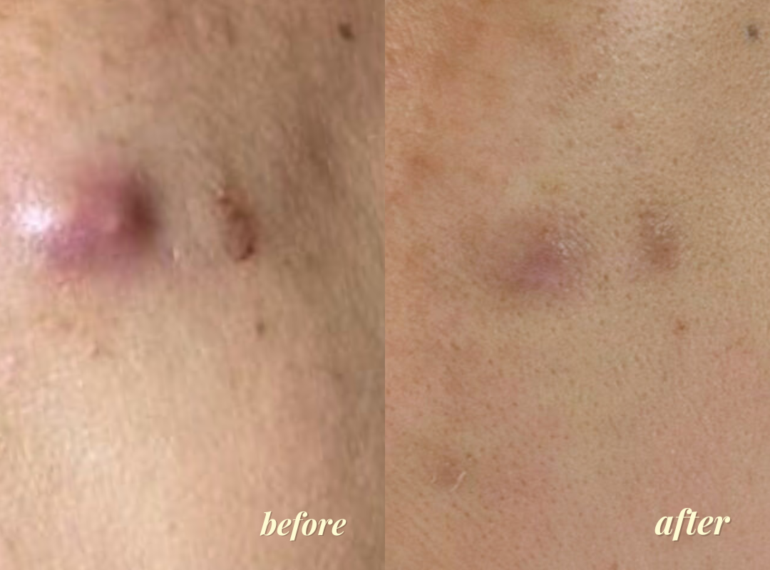 Before and after using BeKind Clear Skin Elixir