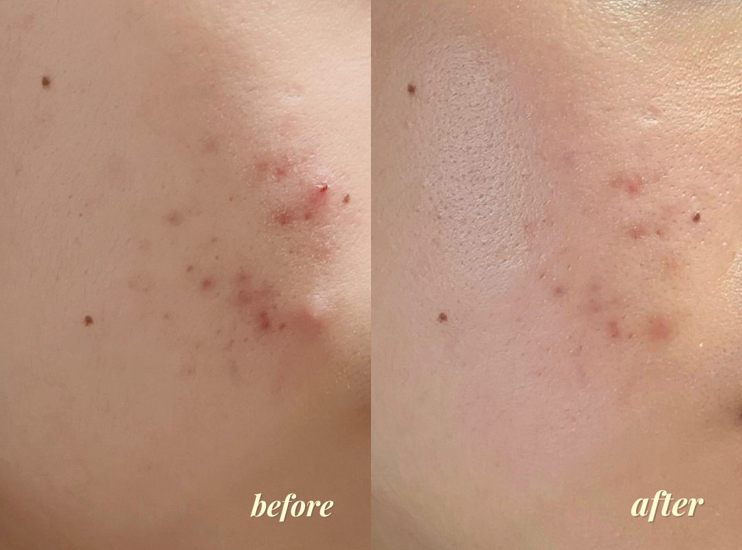 Before and after using BeKind Clear Skin Elixir