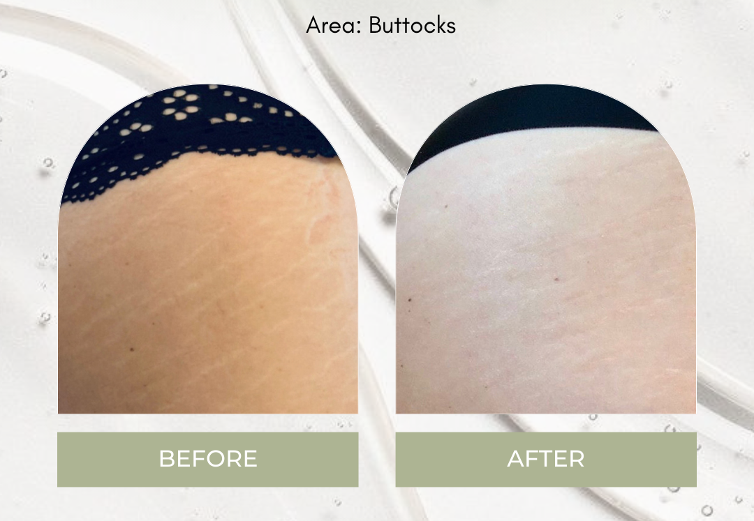 Inkless Skin Camouflage Treatment