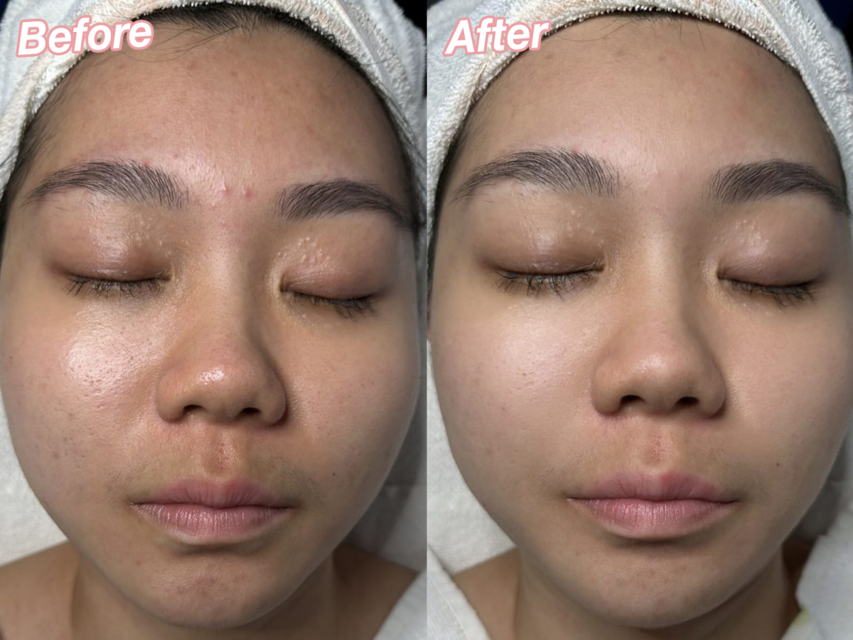 Before and after Cica Acne Treatment at New York Skin Solutions