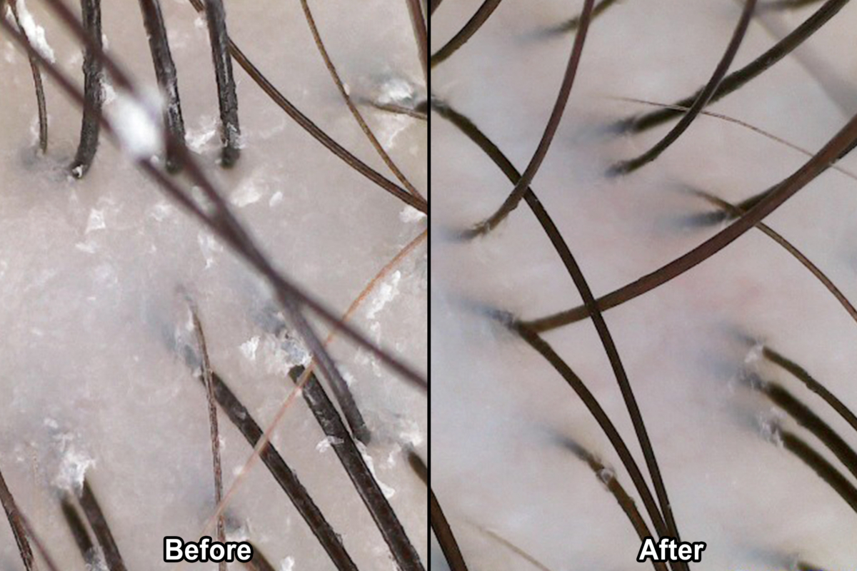 Magnified scan of Jasmin’s scalp after the treatment process