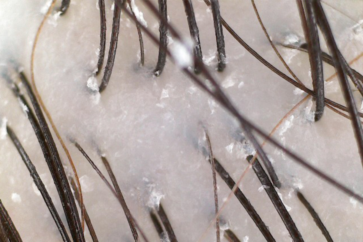 Magnified scan of Jasmin’s scalp before the treatment process