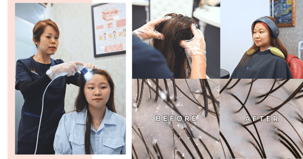 We Tried The Latest Anti-Dandruff Scalp Treatment & Saw Visible Results In One Session