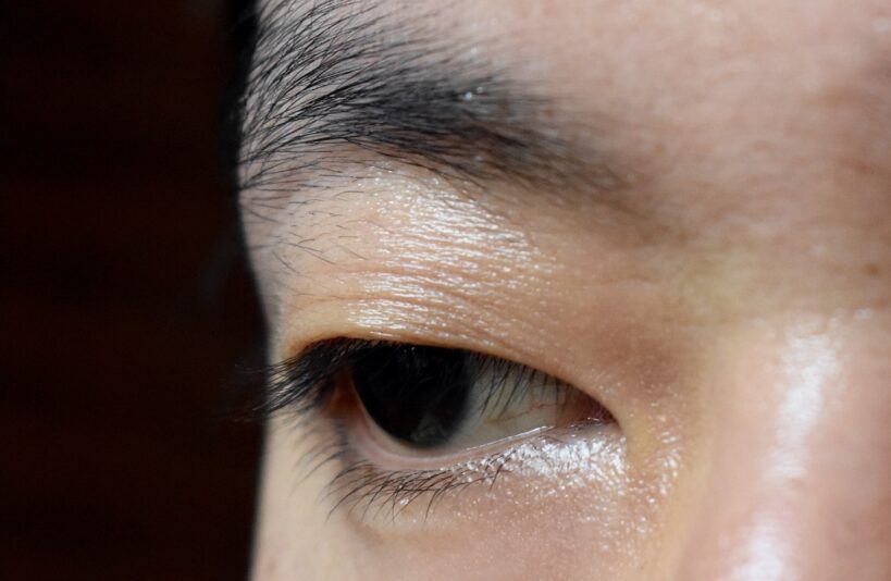 Monolid with signs of ptosis