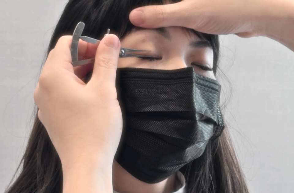 Correcting Ptosis via double eyelid surgery