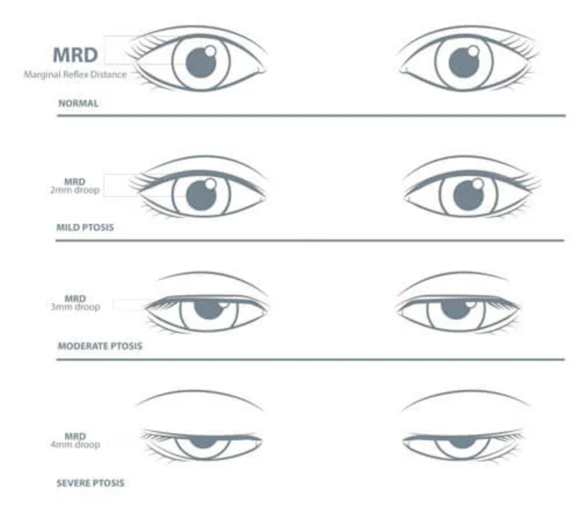 Recognising ptosis, or droopy eyelids