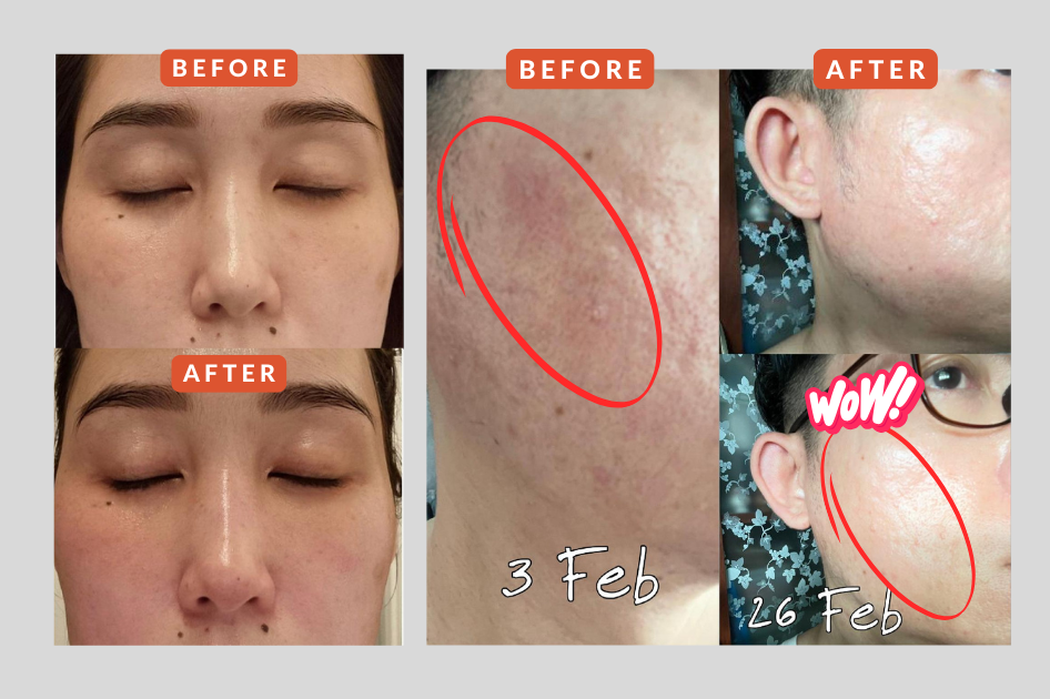 Before & after using Alluora skincare