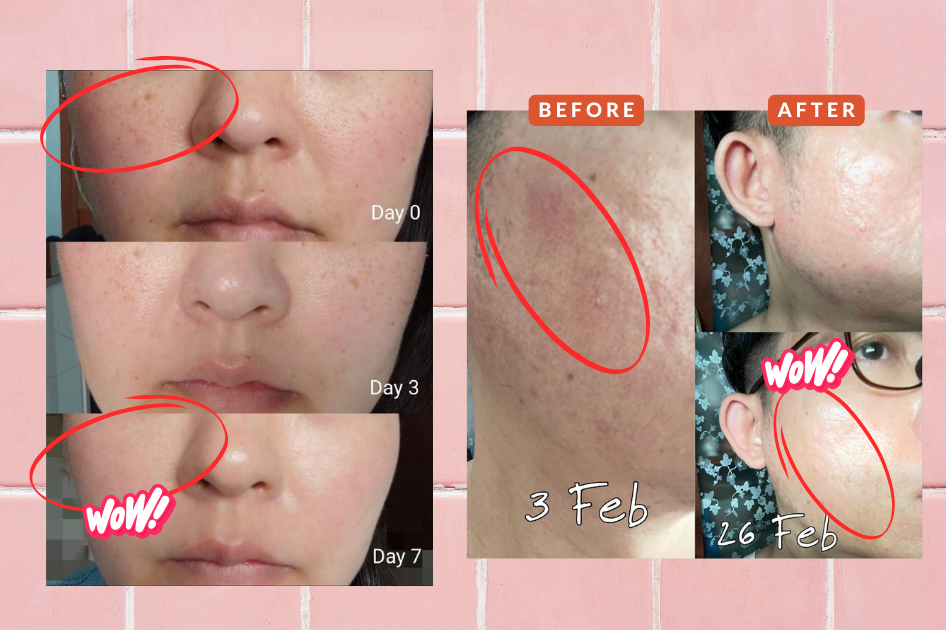 Before & after using Alluora skincare