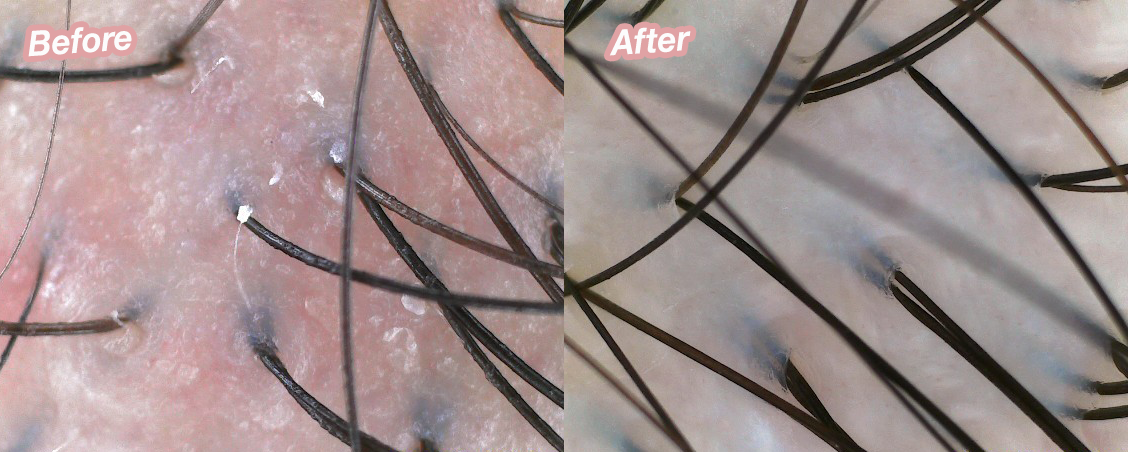 Before & after scalp scan results of TK TrichoKare's Restorative Hydration Treatment