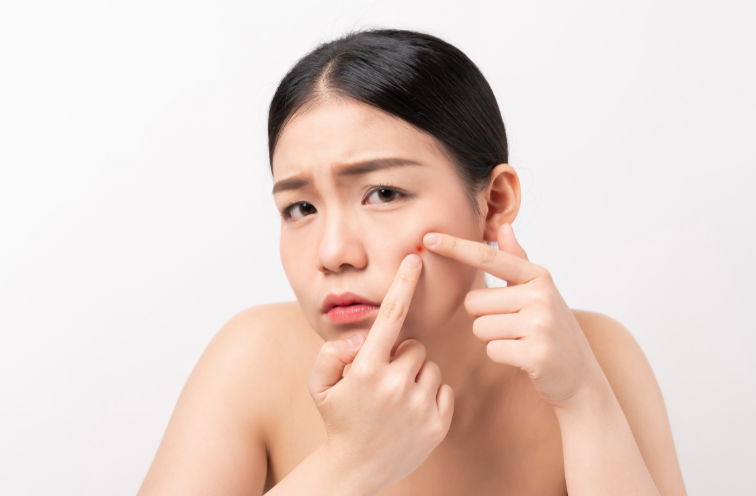 Popping pimples can make things worse by causing more inflammation