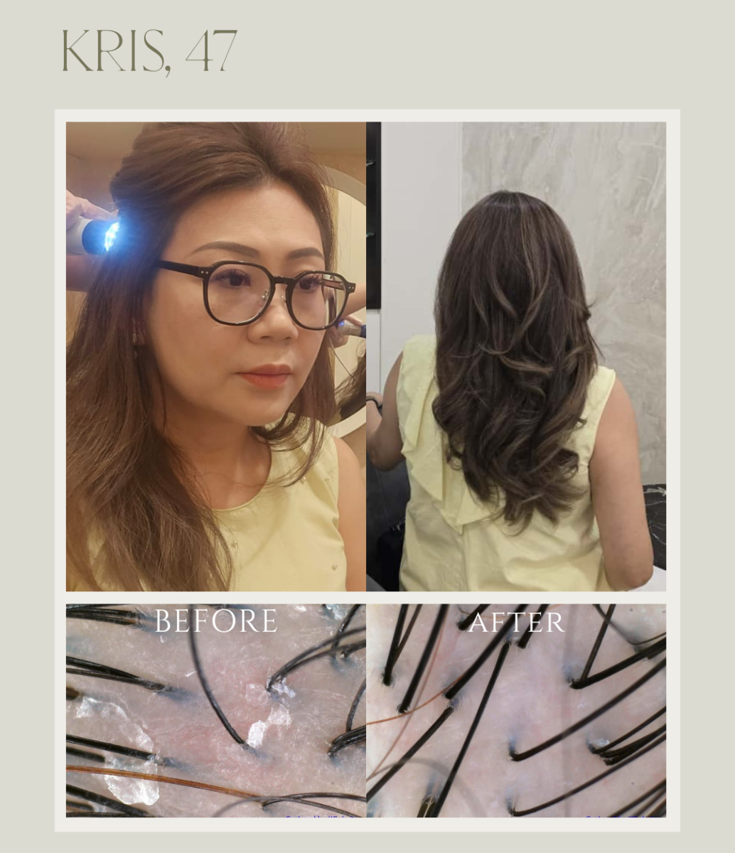 Kris' before & after scalp scans