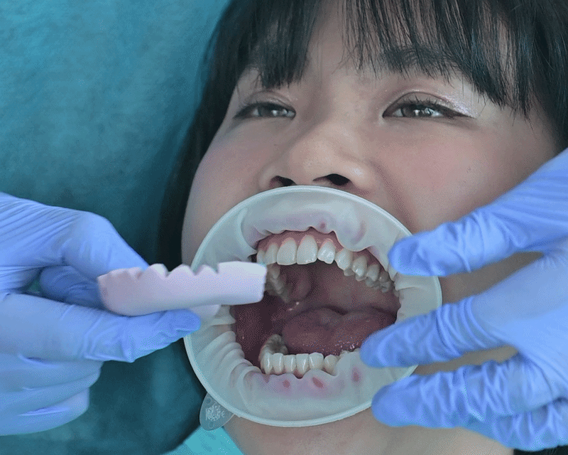 Fitting the Smile Trial mould on my teeth