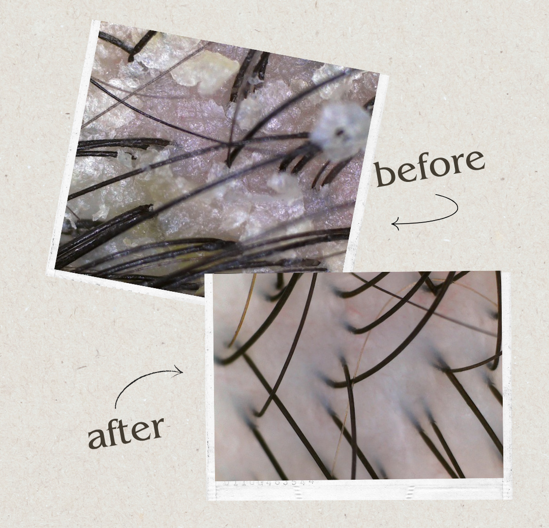 Scalp Purifying Therapy before & after scalp scans