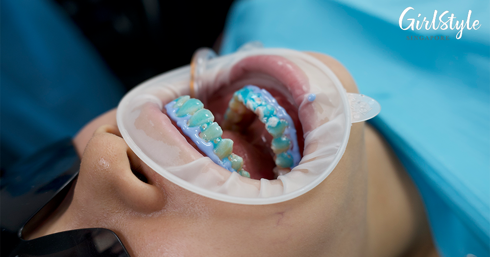 WHITEN+ gel applied on teeth at Dental Designs Clinic