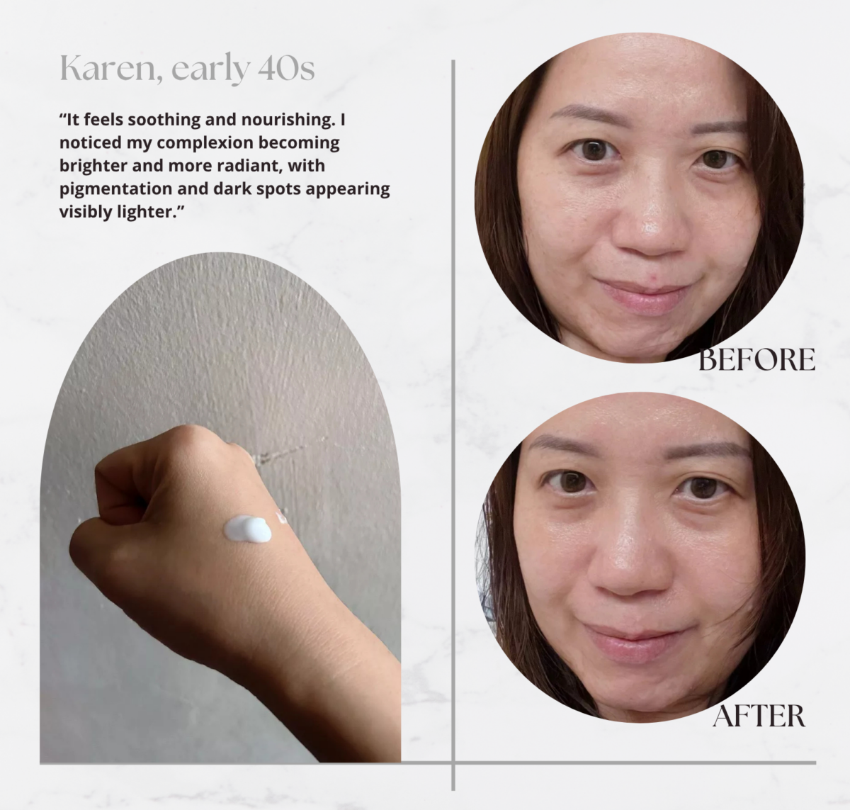 Karen's review and before & after using SHIMBI METHOD Arbutin + Vitamin C 5%, Tranexamic Acid + Dipotassium Glycyrrhizate 1.1% Medicated Serum