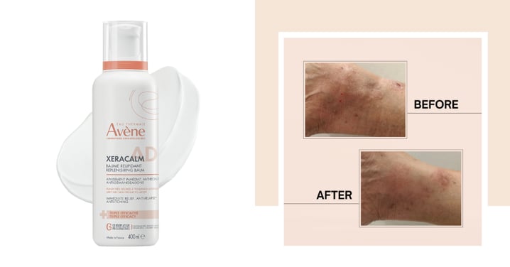 Just 1 Week To Relief & Visibly Improved Skin? 30 Ladies With Dry, Itchy, Sensitive Or Eczema-Prone Skin Tried The New Avène XeraCalm A.D. Lipid-Replenishing Balm